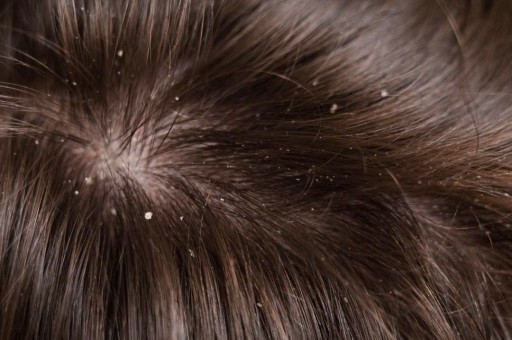 KEPEKTEN NASIL KURTULABİLİRİM?