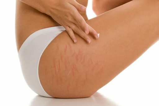 VÜCUT ÇATLAKLARI NASIL YOK EDİLİR?