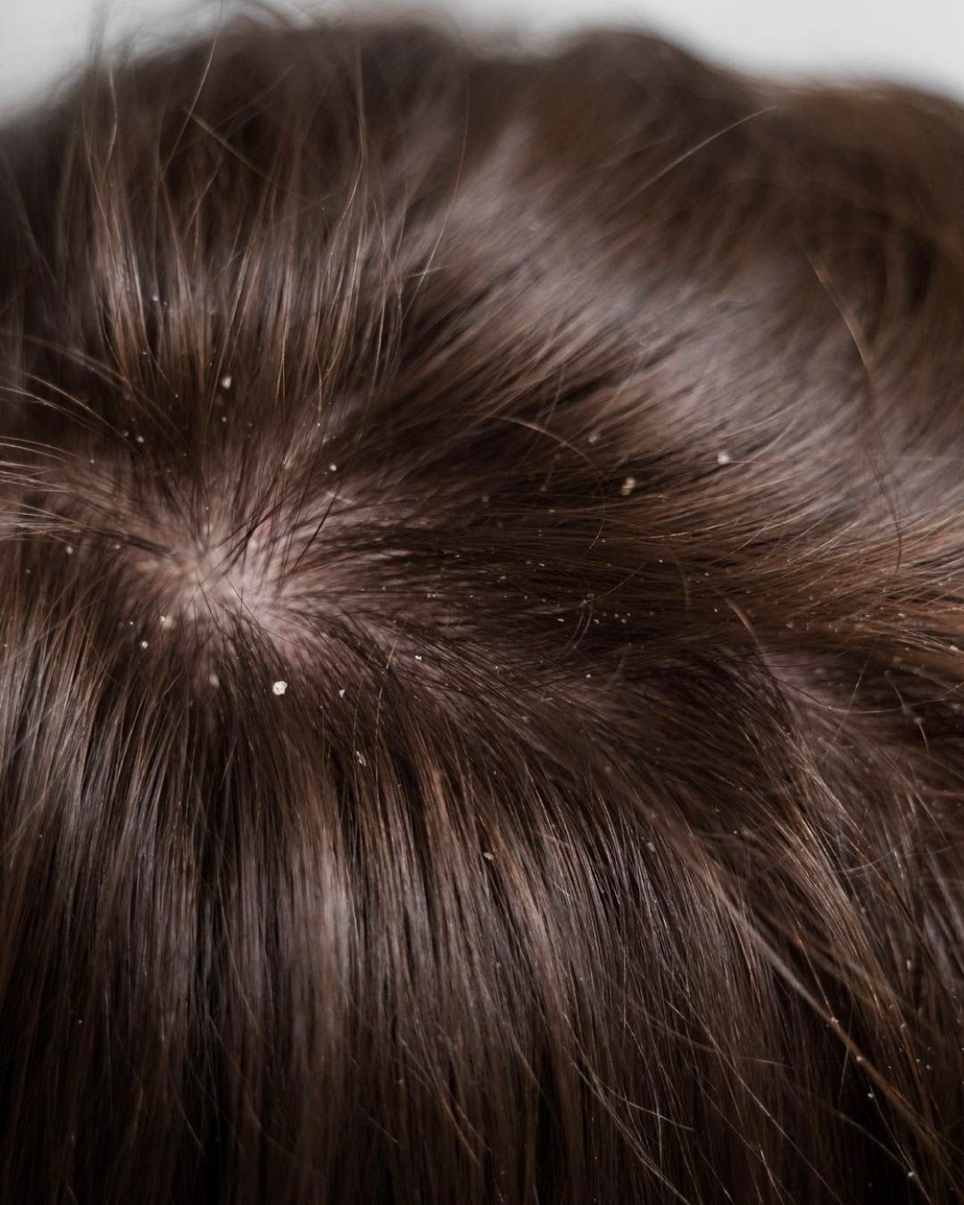 KEPEKTEN NASIL KURTULABİLİRİM?