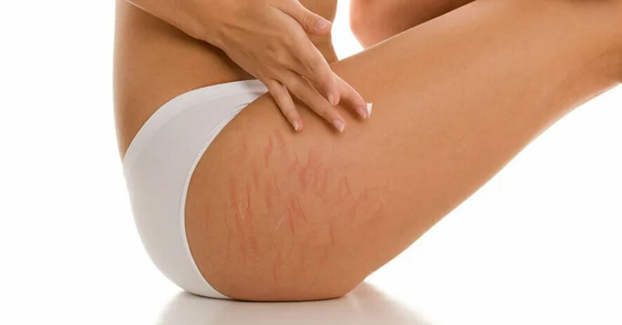 VÜCUT ÇATLAKLARI NASIL YOK EDİLİR?